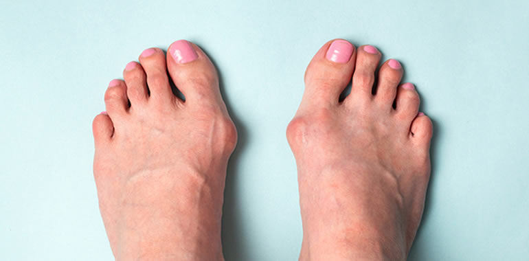 How To Treat Bunion Pain Without Surgery