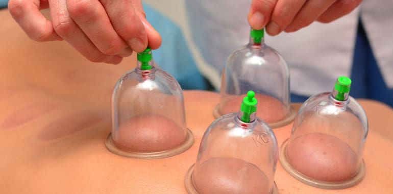 Top 6 FAQ’s about Cupping – AKA: Octopus Marks
