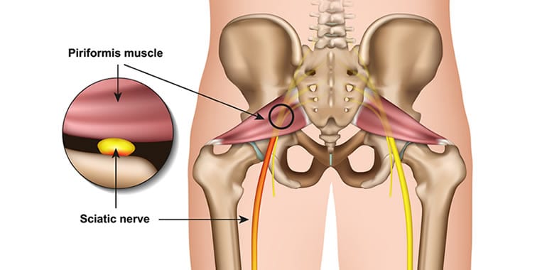 Piriformis Syndrome Versus Sciatica – What Are You Suffering From?