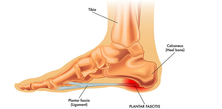 What Is The Best Plantar Fasciitis Treatment?
